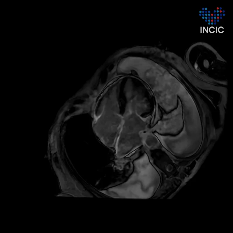 Four-chamber late enhancement: both atria and the interatrial septum enhance
