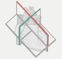 Plano de eje largo (rojo) y de eje corto (verde) sobre el corazón