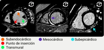 Tipos de realce tardío: subendocárdico, punto de inserción, transmural, mesocárdico y subepicárdico