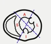 Líneas desde los puntos de inserción que dividen el VI en anterior, septal, inferior y lateral