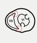 Puntos de inserción del VD en el VI