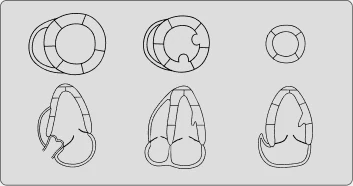 Segmentos vistos en eje corto y en los ejes largos 2C, 4C y 3C