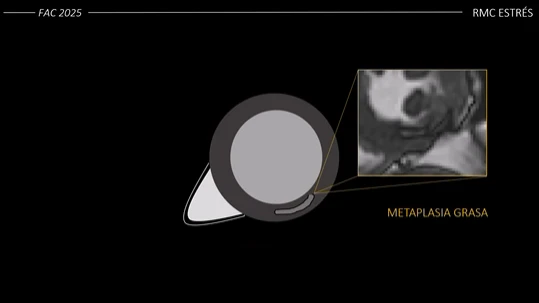 Metaplasia grasa identificada por resonancia cardíaca