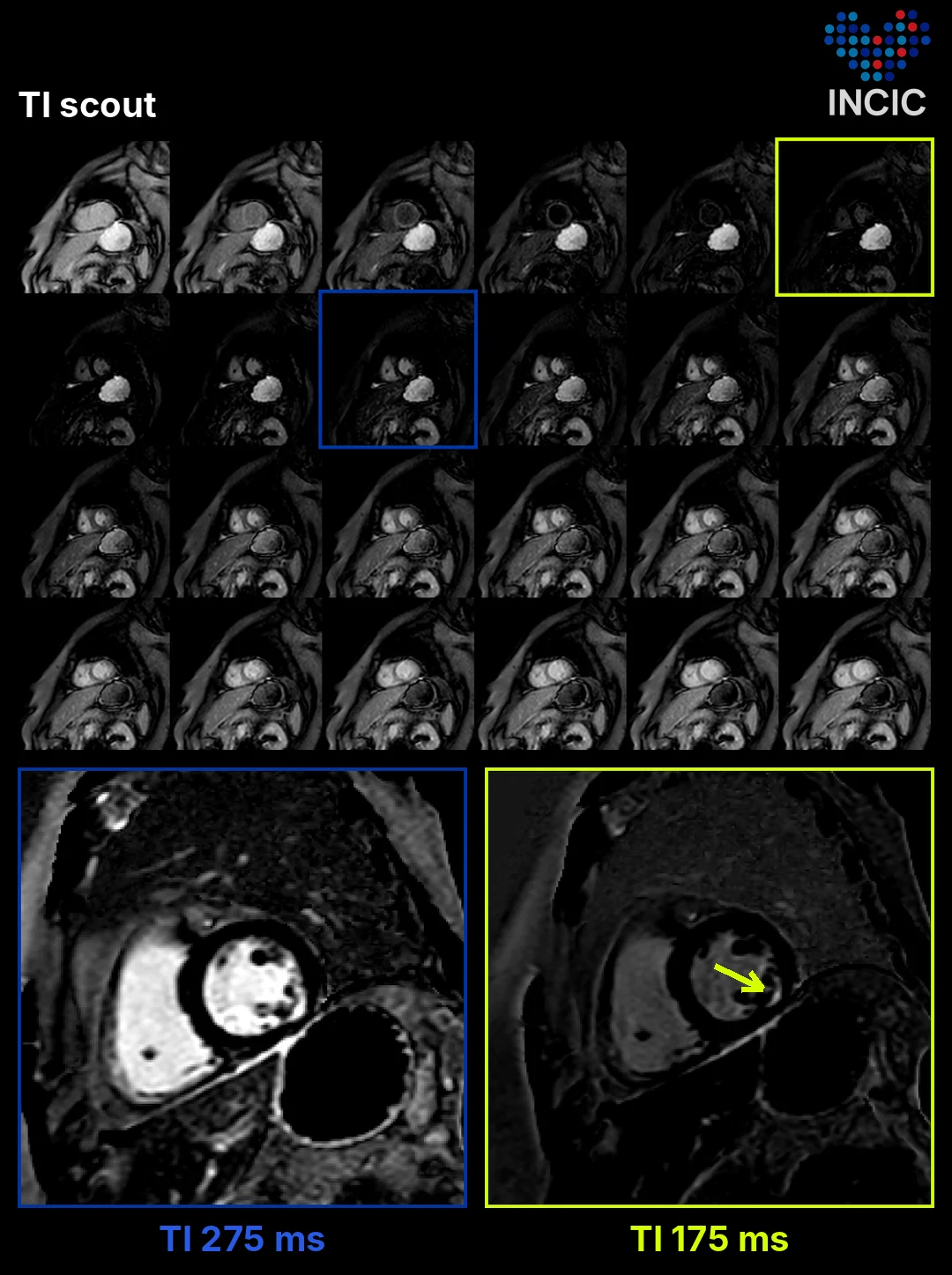 Top, the TI scout. Bottom, the same slice with TI 275 ms (bright blood, blue box) and TI 175 ms (grey blood, yellow box). The arrow marks inferolateral subendocardial enhancement.